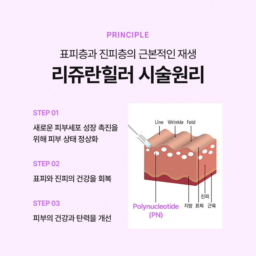 리쥬란힐러 통증 붓기 걱정이라면 관련 이미지 4