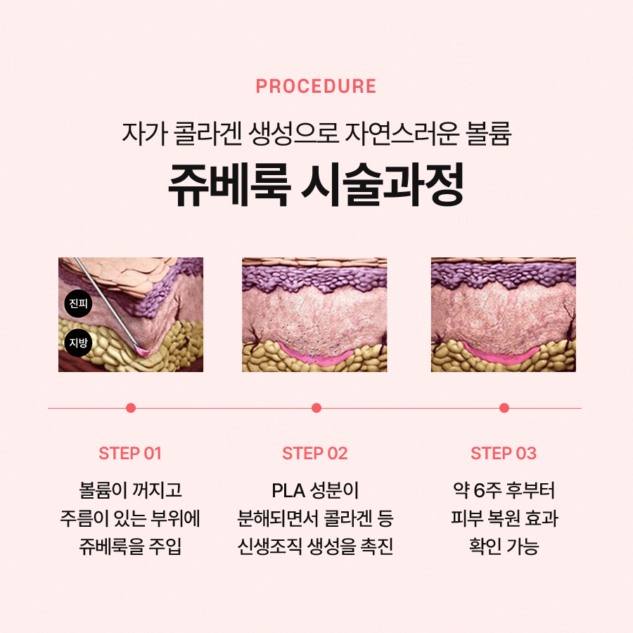 쥬베룩 시술 효과 확인해서 관련 이미지 6
