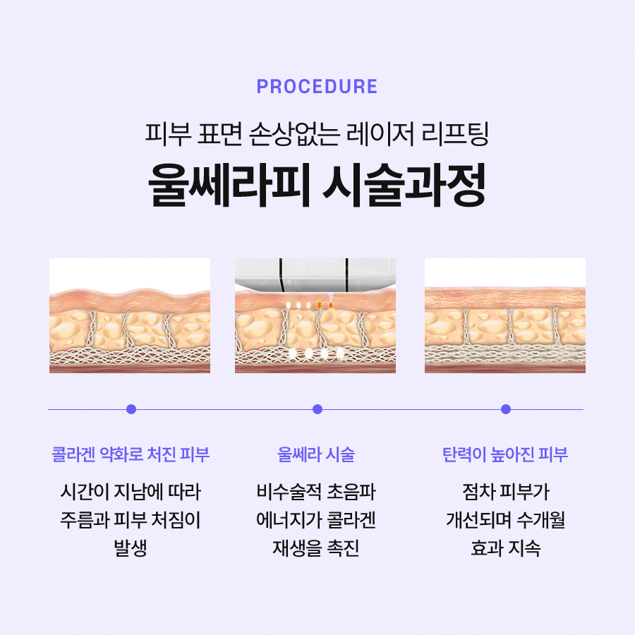 울쎄라프라임 더욱 좋은 효과를 보기 위한 방법 관련 이미지 5