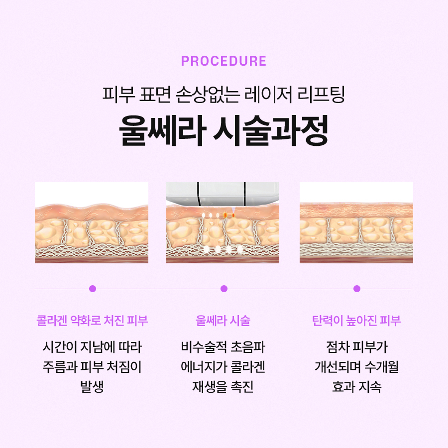 울쎄라리프팅 효과와 시술 과정에 대해 관련 이미지 4