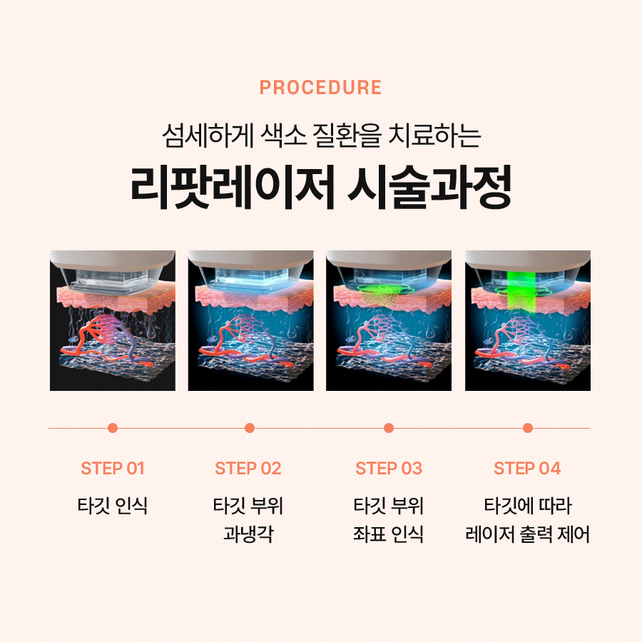 리팟레이저 효과, 얼굴흑자제거 흑자치료 고민이라면 관련 이미지 4
