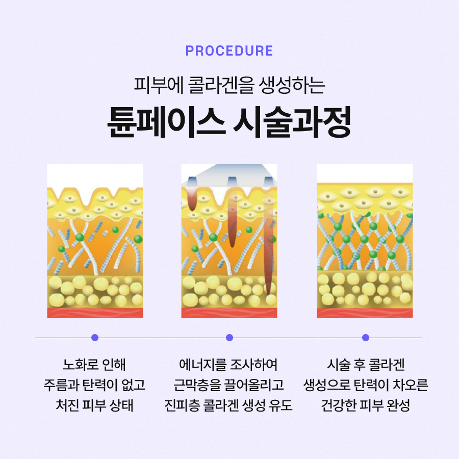튠페이스 시술 효과를 볼 수 있는 대상은? 관련 이미지 5