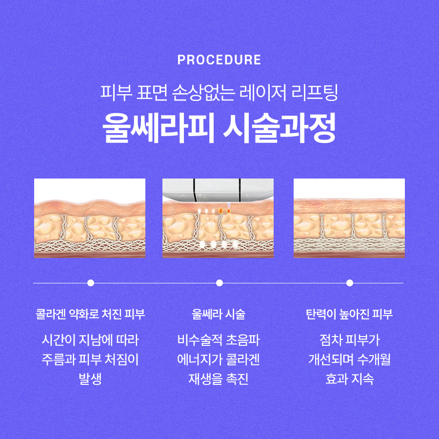 울쎄라2 리프팅 추천 대상과 효과에 대해 관련 이미지 4