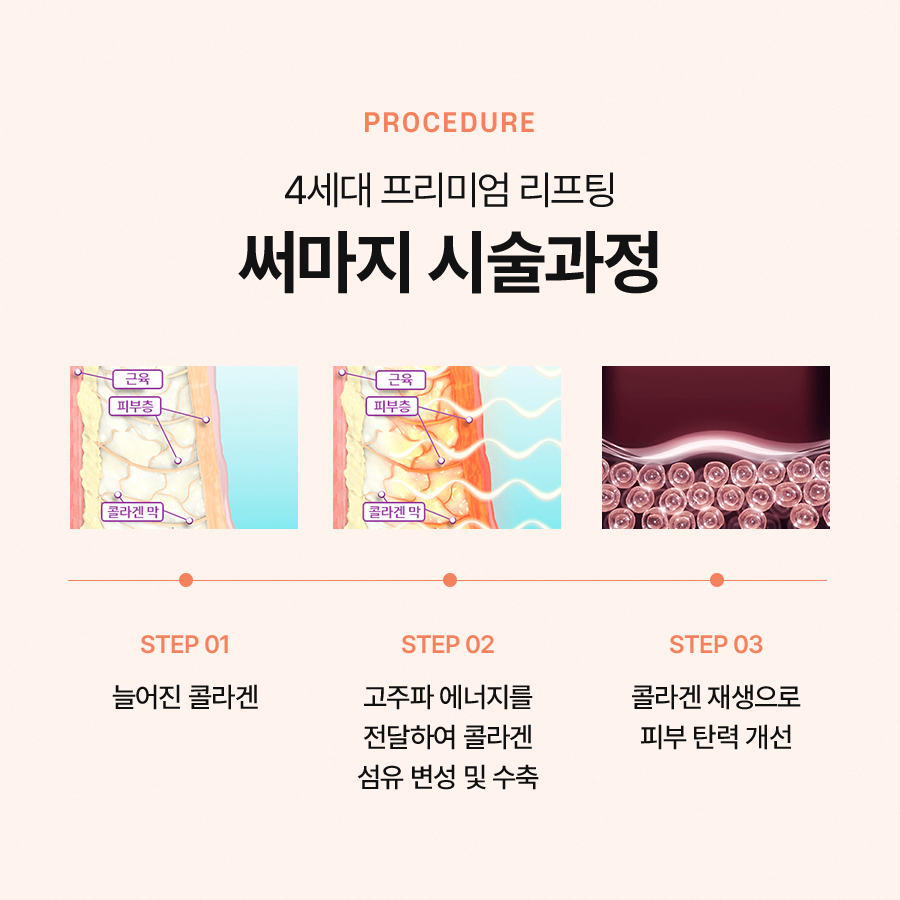 써마지 리프팅 효과와 시술 과정이 궁금하시다면 관련 이미지 4