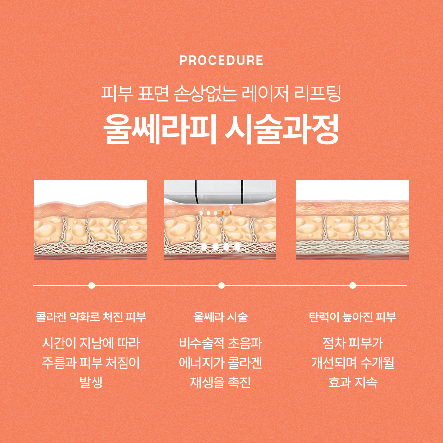 울쎄라피프라임 리프팅 통증 걱정된다면 관련 이미지 3