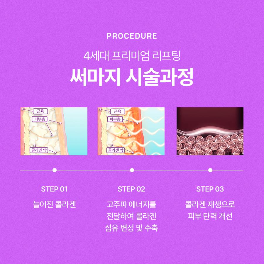 써마지FLX 리프팅 효과 알아보면 관련 이미지 4