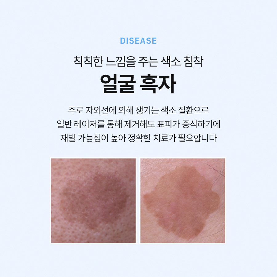 리팟레이저 얼굴 흑자 제거 원한다면 관련 이미지 3