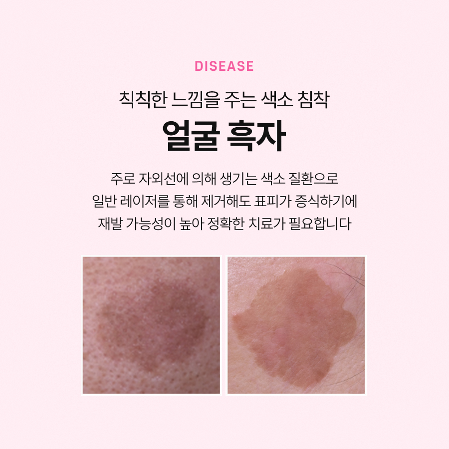 Ripot Laser Is Effective for Treating Pigmentary Disorders image 3