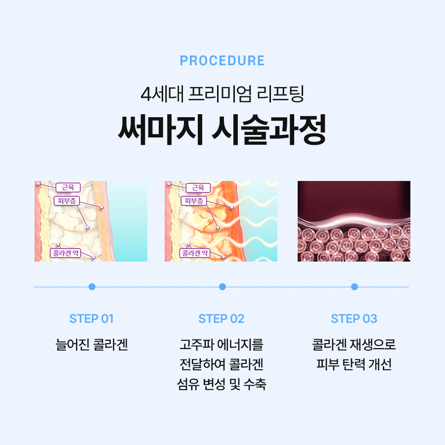 써마지 효과 유지기간 궁금하다면 관련 이미지 4