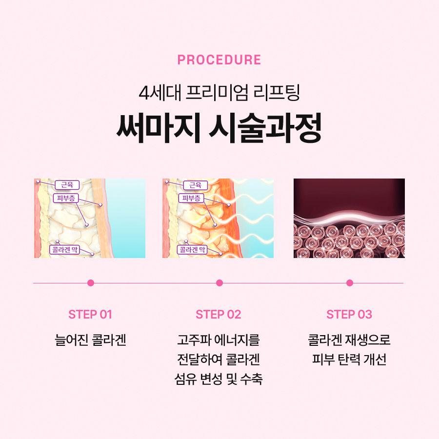 써마지FLX 리프팅 효과 유지기간 알아본다면 관련 이미지 3