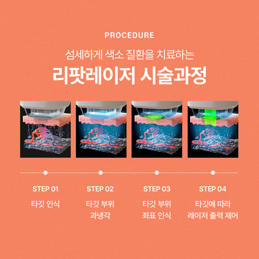 리팟레이저 얼굴흑자 치료하고 싶다면 관련 이미지 4