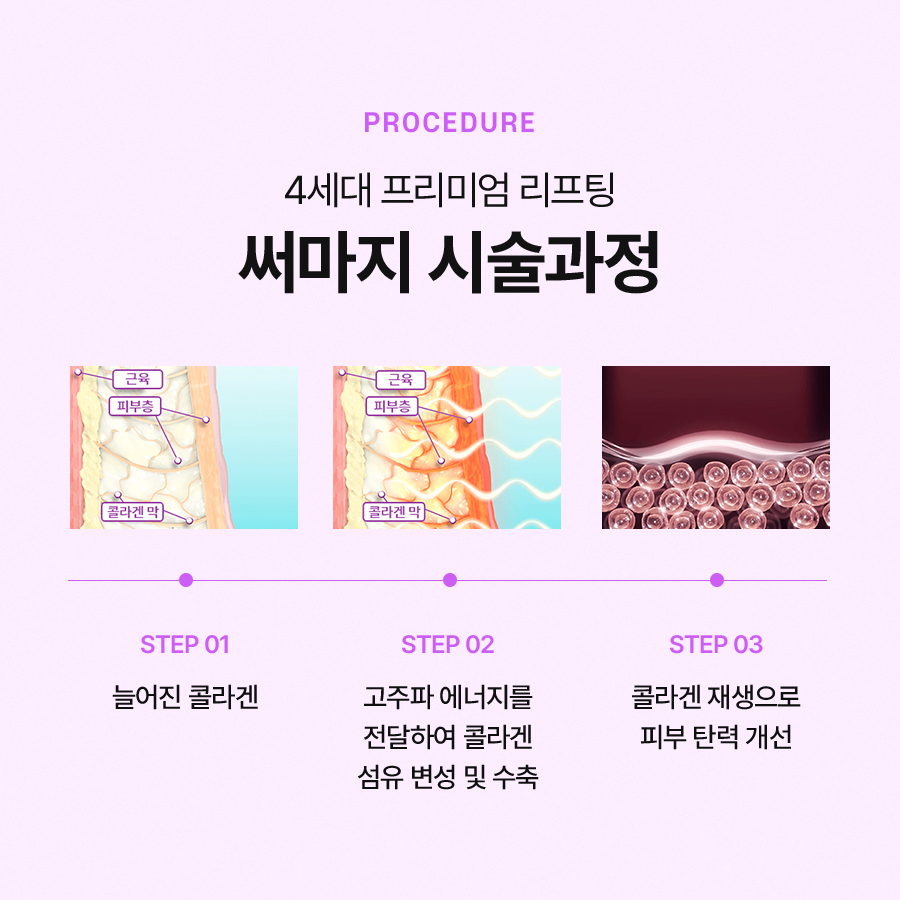 써마지 리프팅 효과, 유지 기간이 궁금하신가요? 관련 이미지 4