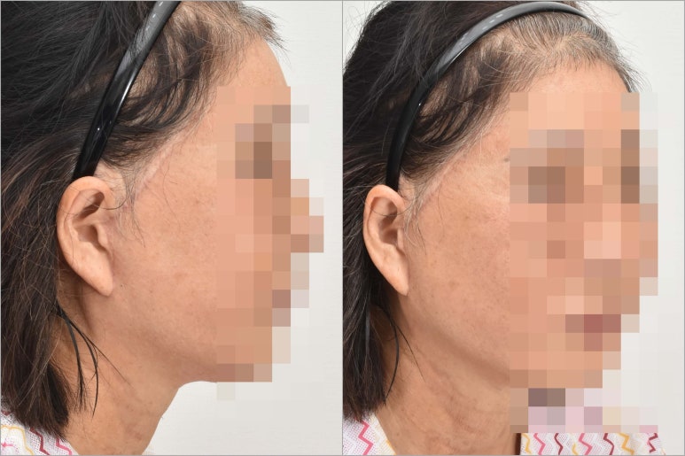 10 Things to Note About Facelift Results and Successful Before-and-After Cases image 3