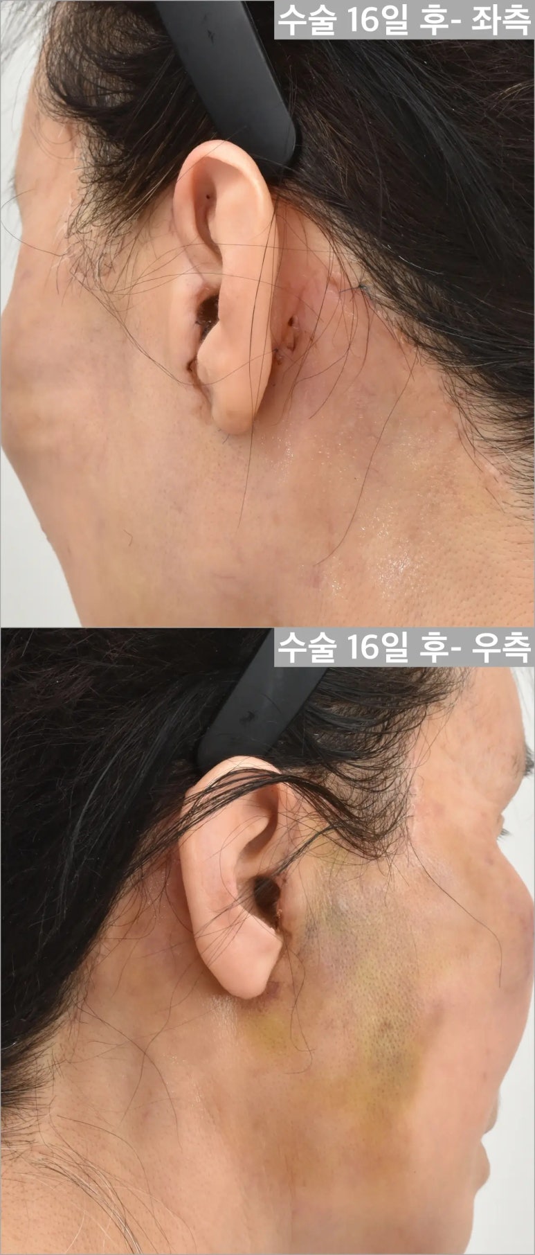 안면거상술, 흉터까지 고려하고 계신가요? 관련 이미지 12