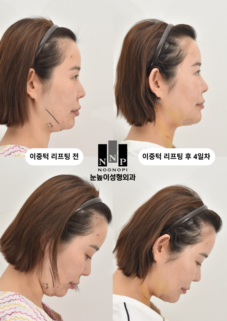 If You're Worried About Inflammation After Summer Plastic Surgery image 10