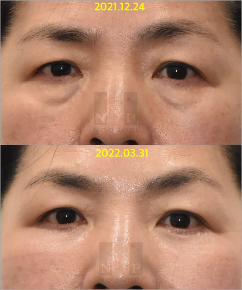 Lower Blepharoplasty vs. Fat Repositioning for Under-Eye Bags - Which Under-Eye Surgery Is Right for Me? image 8