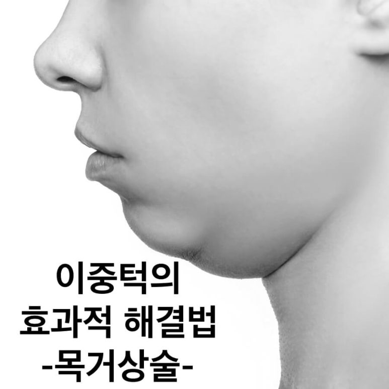 성형외과에서는 이중턱 리프팅을 이렇게 권한다(목거상수술) 관련 이미지 1
