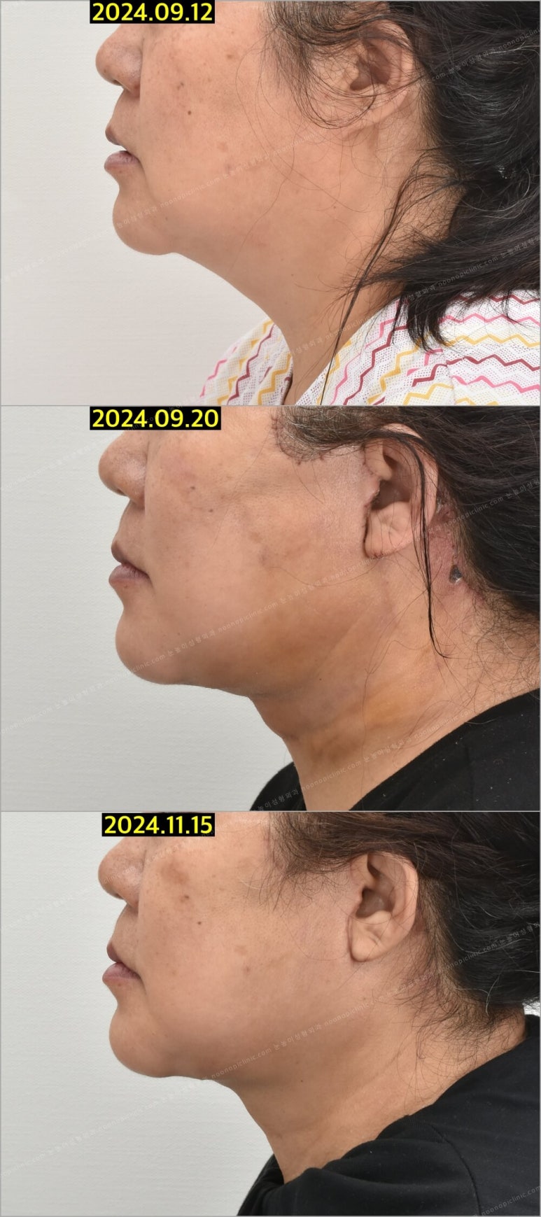 Facelift Scars and Recovery Time image 13
