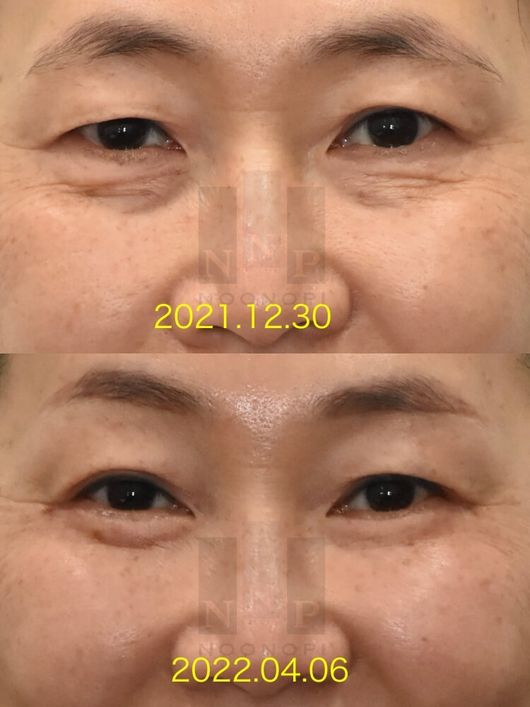 Lower Blepharoplasty vs. Fat Repositioning for Under-Eye Bags - Which Under-Eye Surgery Is Right for Me? image 12