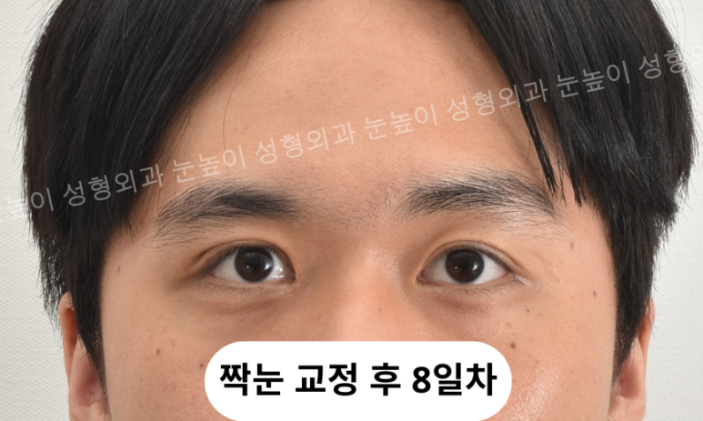 If You're Worried About Inflammation After Summer Plastic Surgery image 9