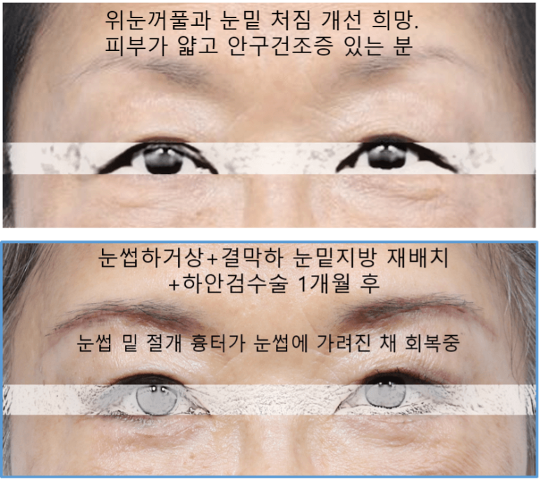 눈썹하거상술 절개 흉터가 신경 쓰이세요? 관련 이미지 5