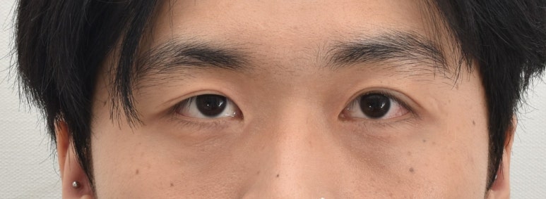 눈매교정 재수술 사례 : 고객과 합심해서 만든 결과 관련 이미지 4