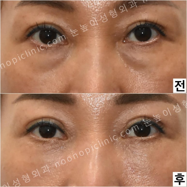 Were you curious about swelling and recovery after lower blepharoplasty? image 4