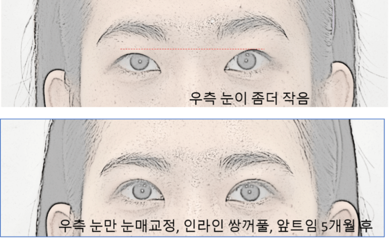 눈매교정과 쌍수 중 나에게 최선은? 관련 이미지 5