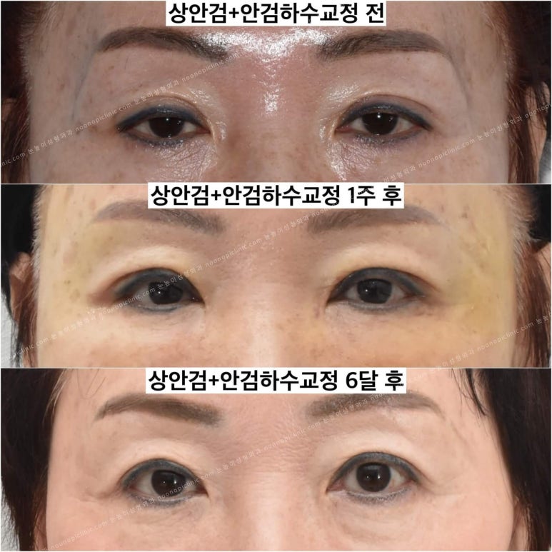상안검수술하려는데 안검하수가 웬 말? 관련 이미지 11