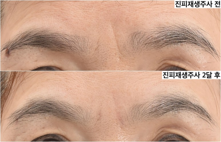 이마거상 이마주름과 미간주름 얼마나 좋아질까 관련 이미지 3