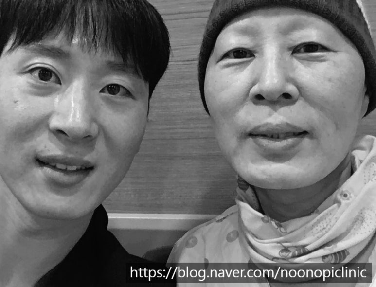 가족에게 추천한 눈밑하안검수술 24개월 경과 관련 이미지 2
