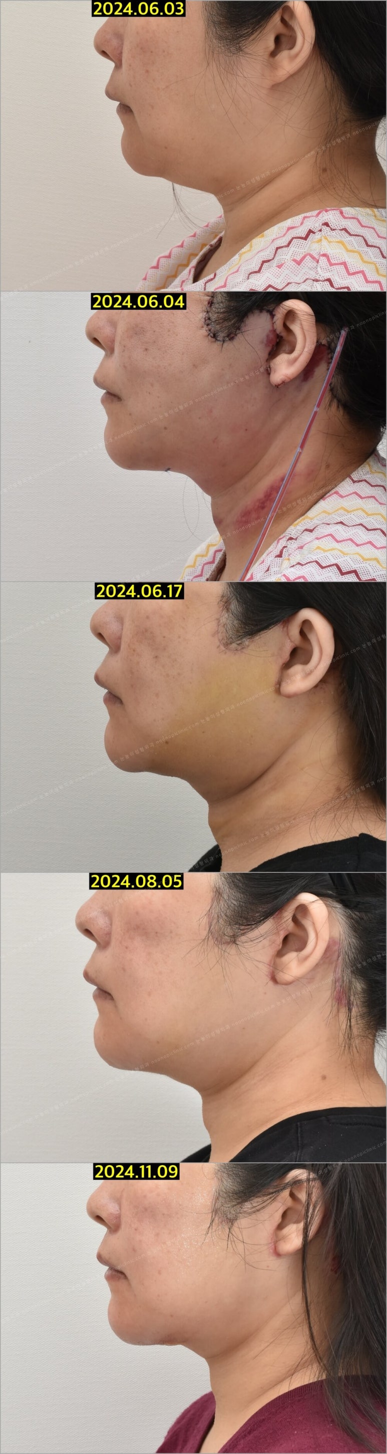 Facelift Scars and Recovery Time image 2