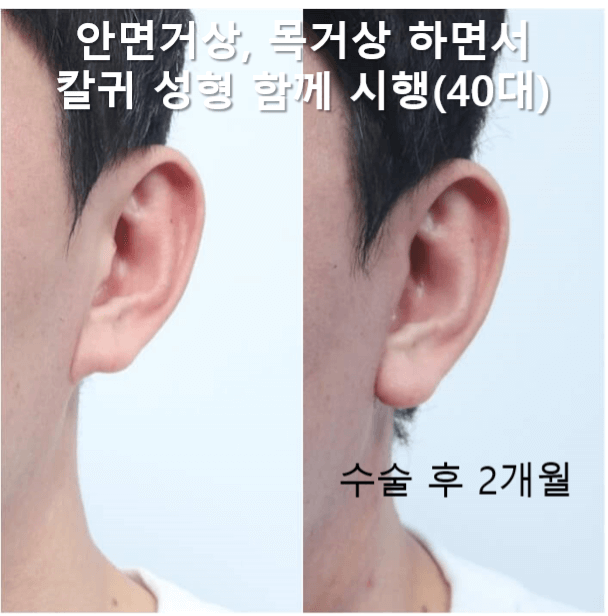 안면거상술 생각하는데 부작용 걱정 되세요? 관련 이미지 3