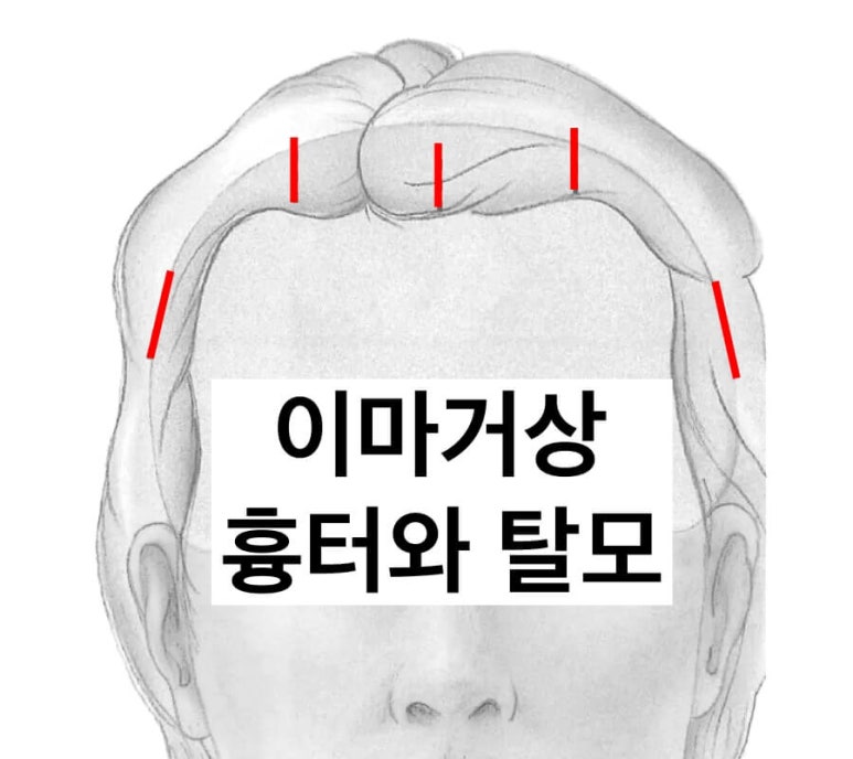 Brow Lift Scars and Hair Loss image 2