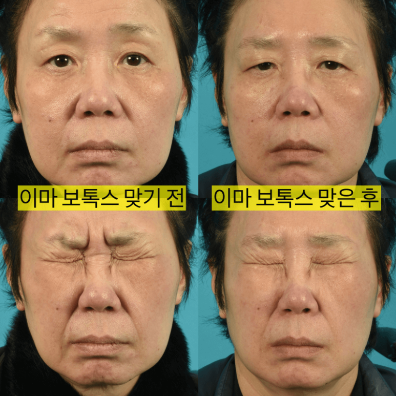 중년 눈수술! 사나워지자고 하는게 아니잖아요 :  조영구 성형에 관한 눈높이성형외과의 견해 관련 이미지 6