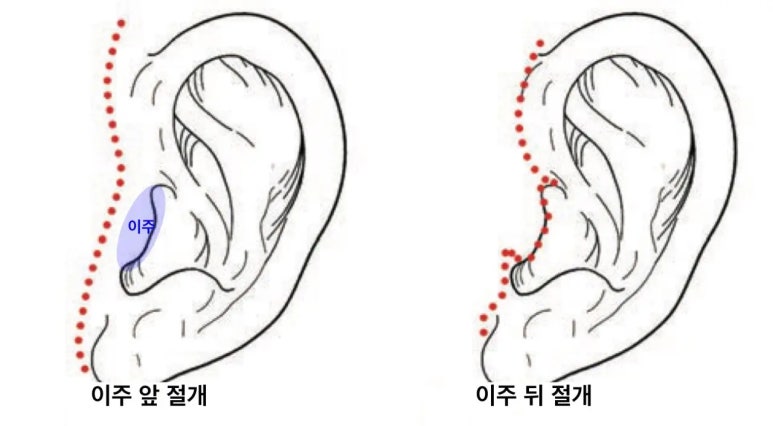 안면거상술, 흉터까지 고려하고 계신가요? 관련 이미지 5