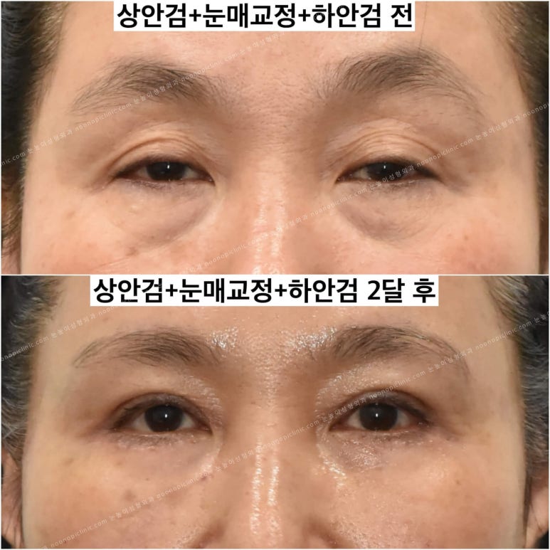 상안검수술하려는데 안검하수가 웬 말? 관련 이미지 8