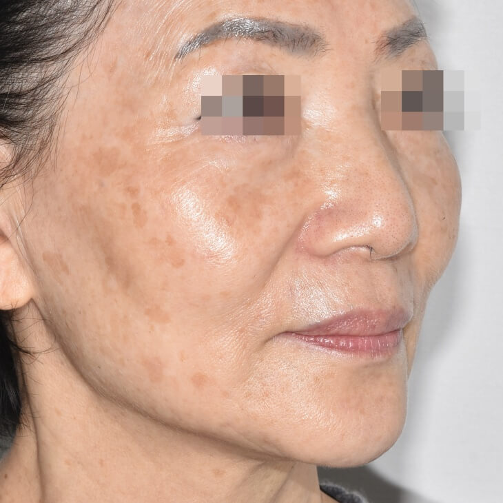 토닝 레이저 한 번으로 기미가 얼마나 좋아질까? 관련 이미지 5