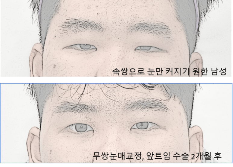 눈매교정과 쌍수 중 나에게 최선은? 관련 이미지 4