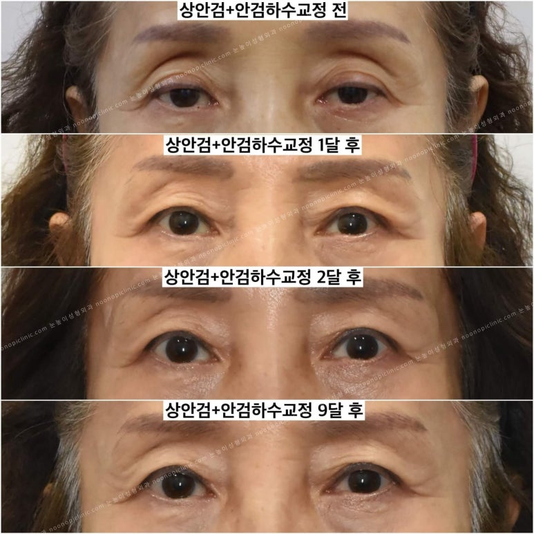 상안검수술하려는데 안검하수가 웬 말? 관련 이미지 9