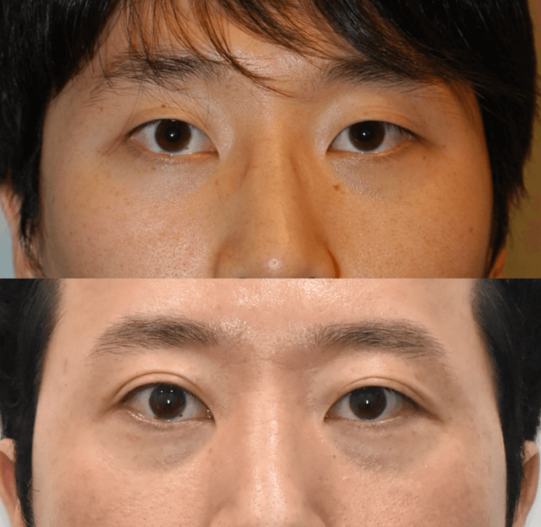Were you curious about swelling and recovery after lower blepharoplasty? image 2