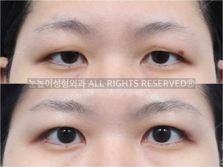 성형외과 전문의가 말하는 아름다운 눈이란 관련 이미지 8