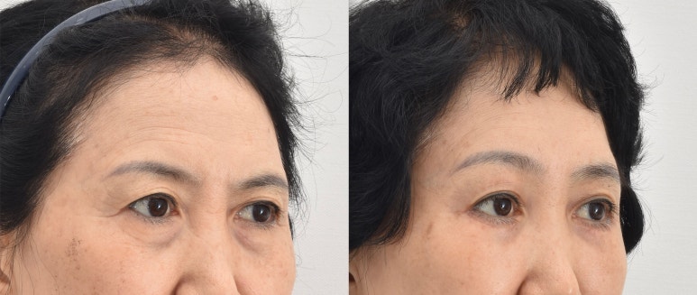 If You’re Looking Into Cosmetic Surgery as a Mother’s Day Gift for Your Parents image 8