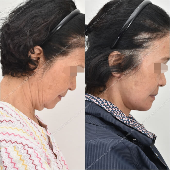 10 Things to Note About Facelift Results and Successful Before-and-After Cases image 12