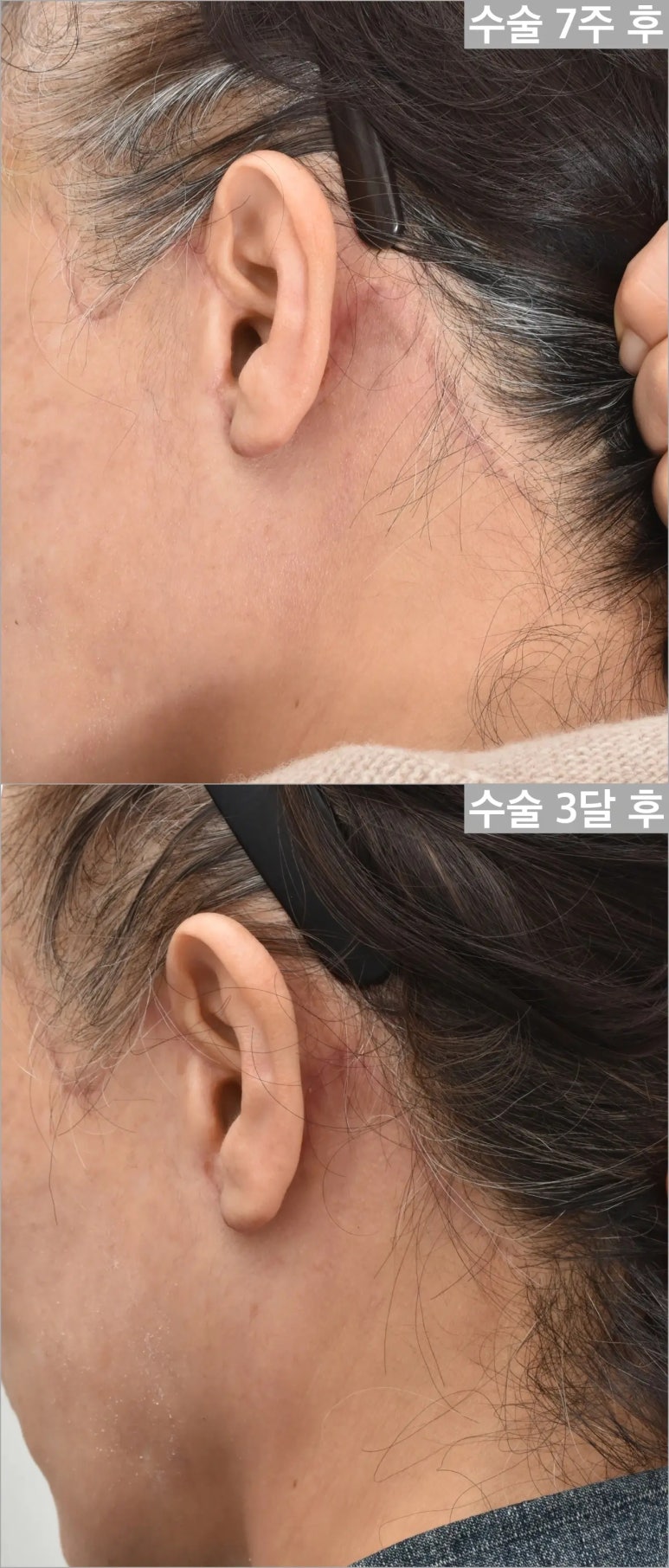 안면거상술, 흉터까지 고려하고 계신가요? 관련 이미지 13