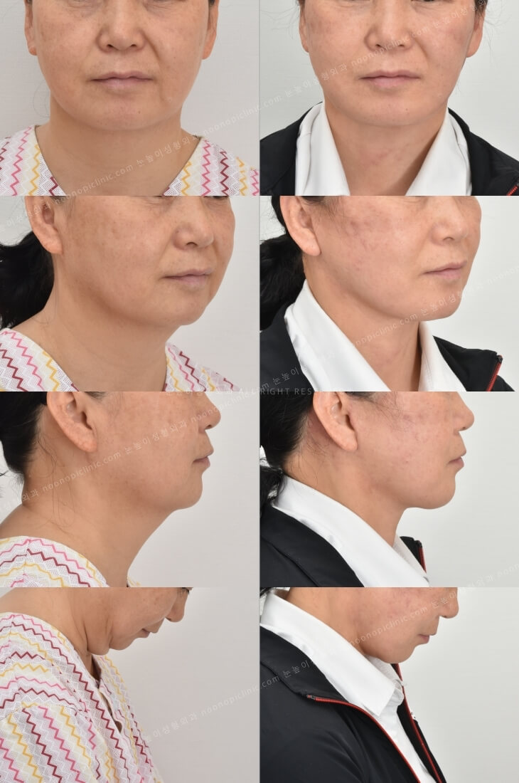 이중턱 치료 : 목거상술의 실제 효과는? 관련 이미지 4