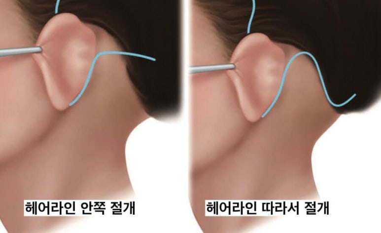 안면거상에서 시행하는 절개 위치는? 관련 이미지 6