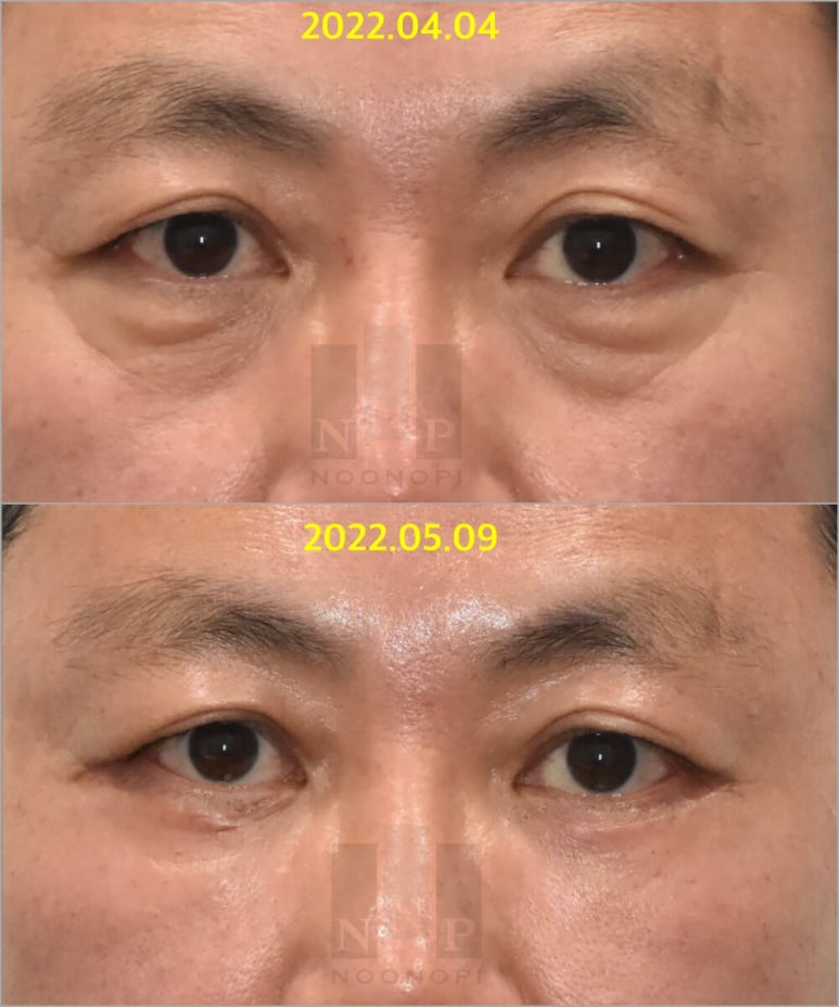 Lower Blepharoplasty vs. Fat Repositioning for Under-Eye Bags - Which Under-Eye Surgery Is Right for Me? image 10