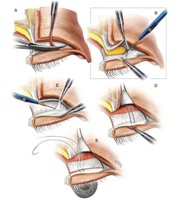What Is Ptosis? Is Eye Correction Essential in Double Eyelid Surgery? image 3