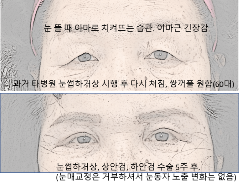 Do I Need Ptosis Correction When Getting Upper Blepharoplasty? image 3